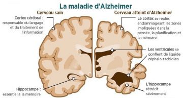 Alzheimer : Une Bactérie Buccale Soupçonnée D’être à L’origine De La ...