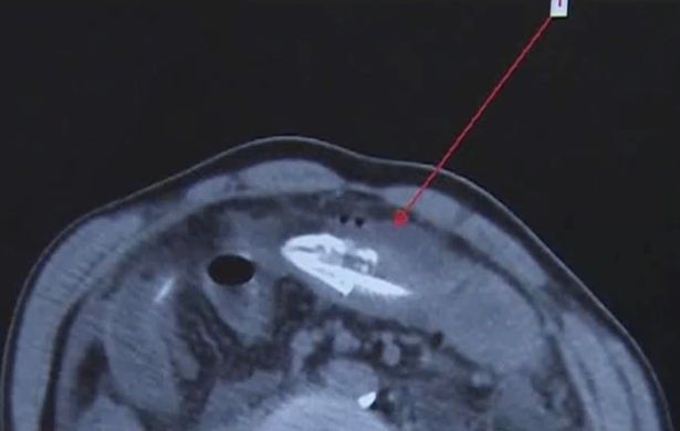 Une radiographie montrant l'anguille dans l'estomac du patient chinois.