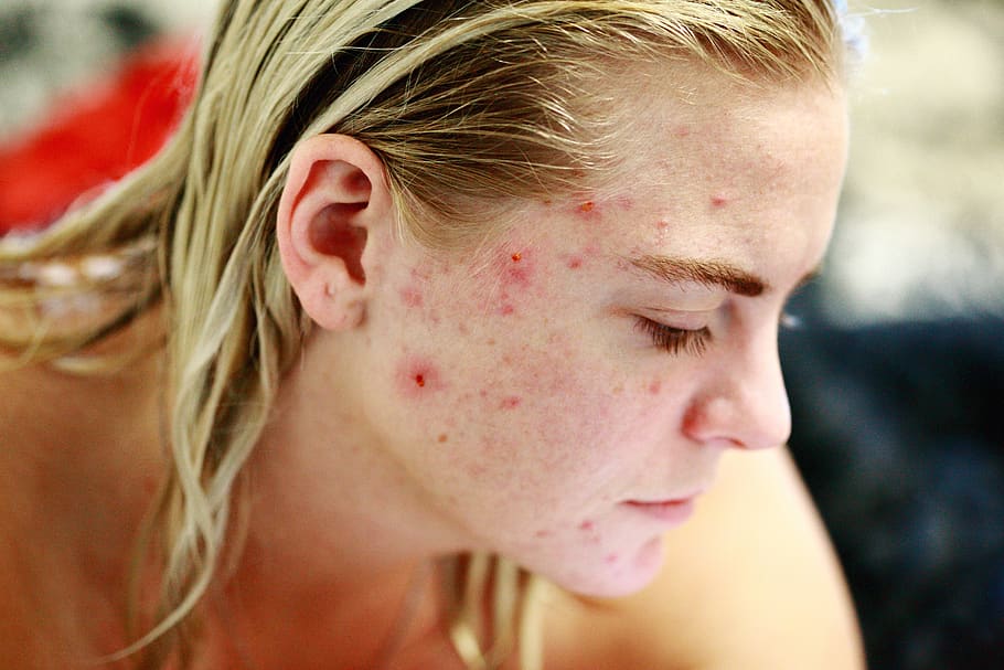 Une jeune fille atteinte d'acné sévère.