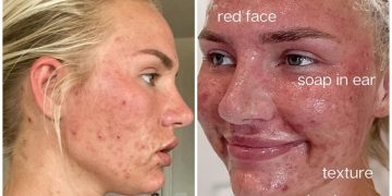 Mik Zazon dévoile sa peau avec de l'acné sur Instagram.