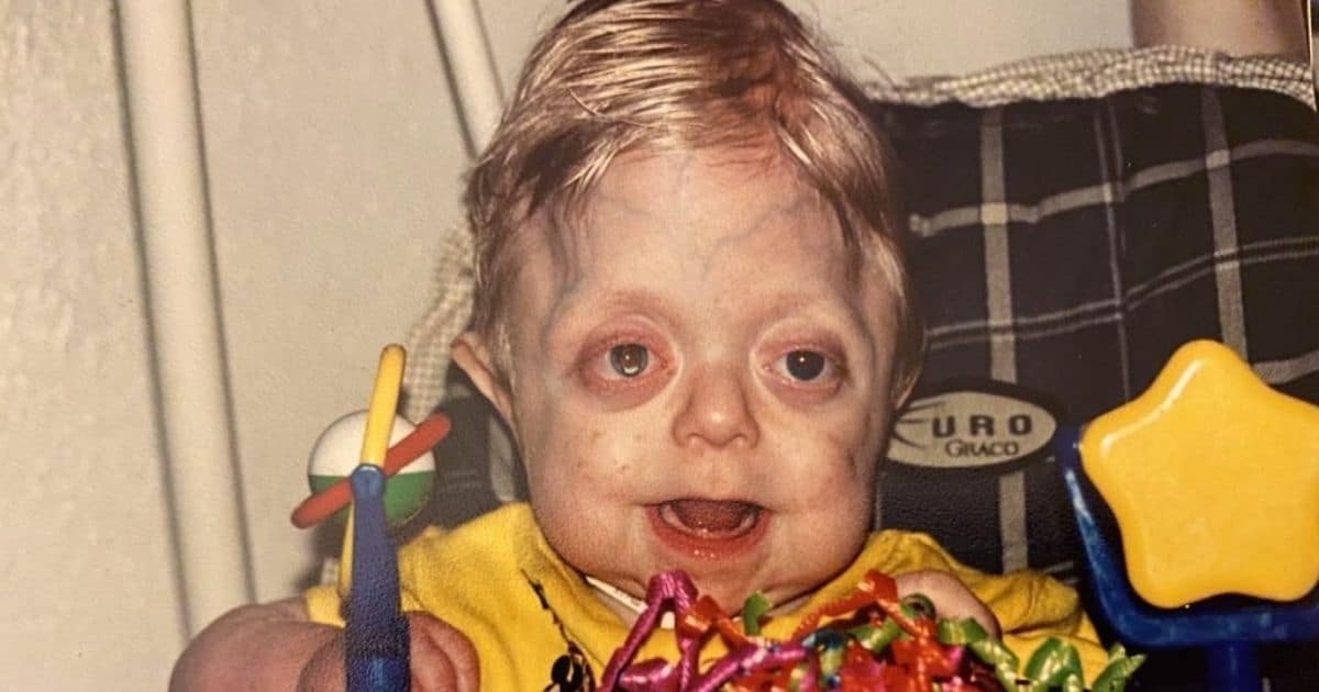 Ce bébé "déformé" célèbre ses 18 ans alors qu'il était condamné par les médecins à la naissance