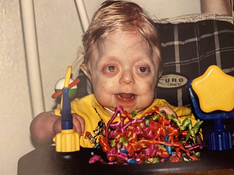 Ce bébé "déformé" célèbre ses 18 ans alors qu'il était condamné par les ...
