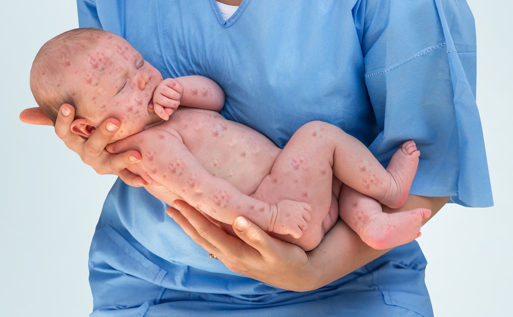Un bébé avec la rougeole