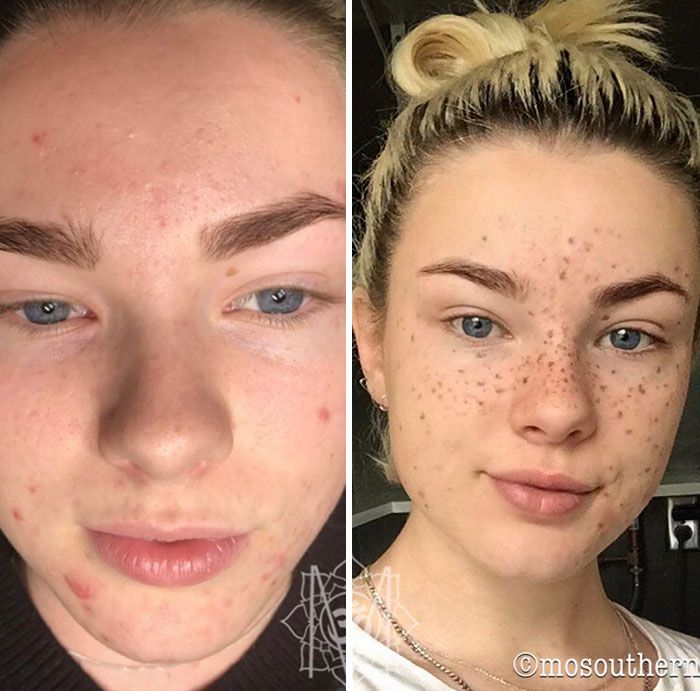 tatouage freckling taches de rousseur