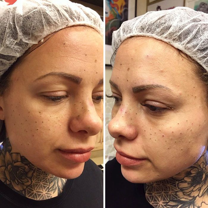 tatouage freckling taches de rousseur