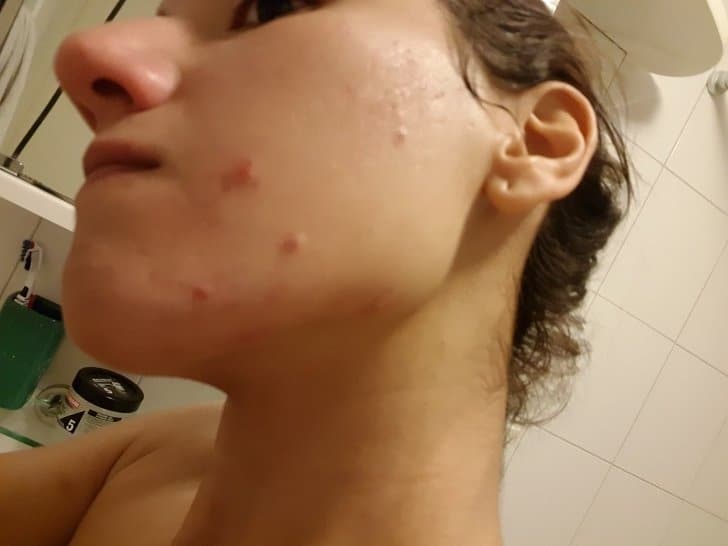 Kasumi Kriss avec de l'acné