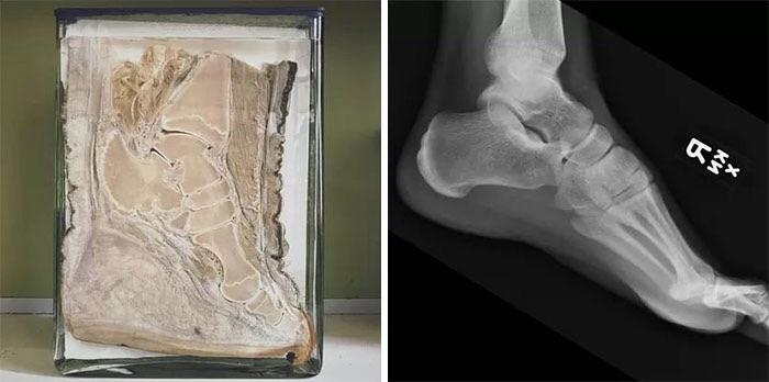 Patte d'éléphant comparée à un pied d'homme