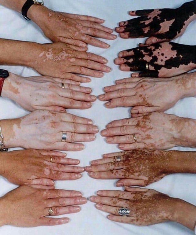 Mains de personnes atteintes de vitiligo