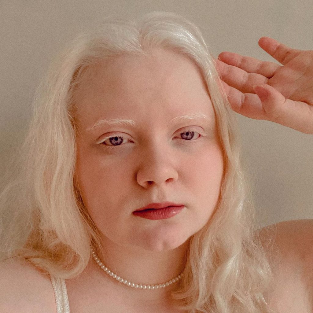 Une femme albinos