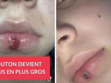 Un bouton de grossesse appelé granulome pyogène.