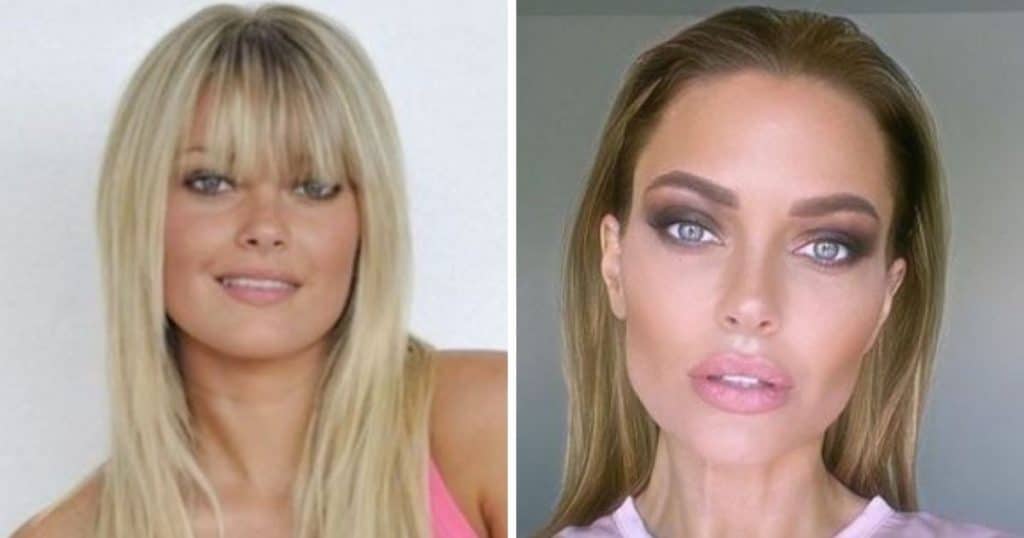 Caroline Receveur avant et après la chirurgie esthétique
