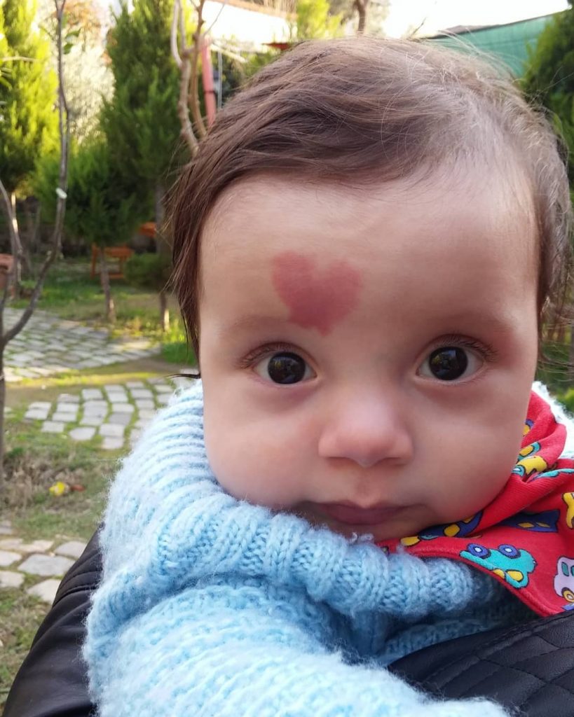 Çinar Engin avec sa tache de naissance en forme de coeur