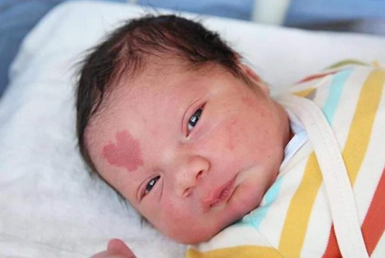 Un Bebe Nait Avec Une Tache De Naissance En Forme De Coeur 5 Ans Plus Tard A Quoi Ressemble T Il