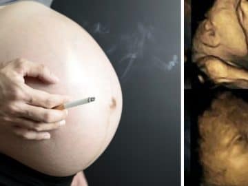 L'échographie 4D du foetus d'une mère fumeuse.