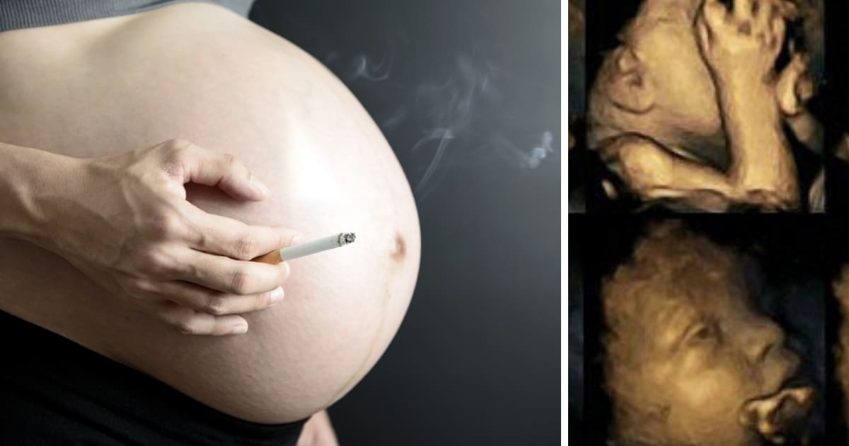 L'échographie 4D du foetus d'une mère fumeuse.