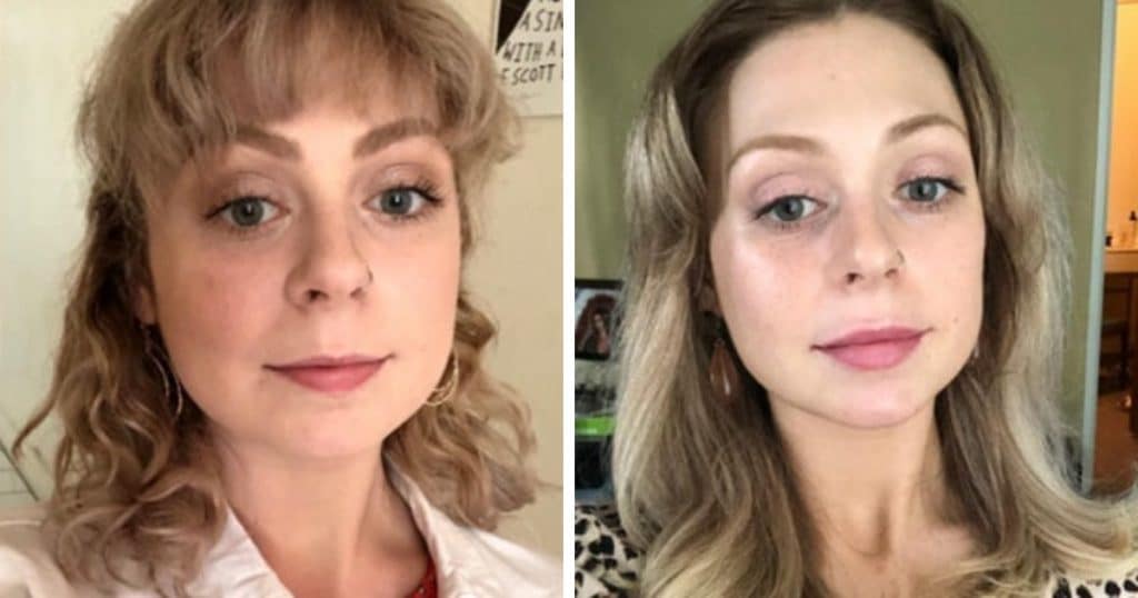 une femme avant et après une opération esthétique