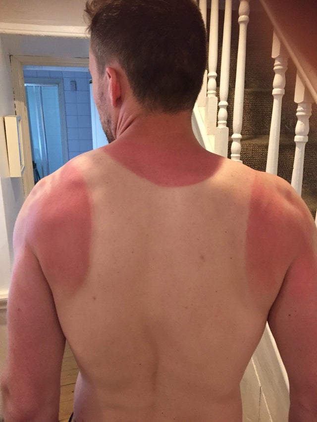 Un homme avec un coup de soleil