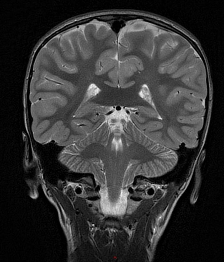 la radio d'un cerveau