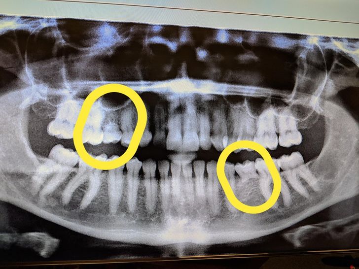 la radiographie d'une bouche avec piercings