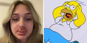 Jade - Homer Simpson - lèvres - opération