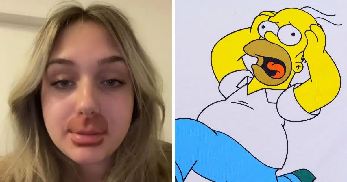 Jade - Homer Simpson - lèvres - opération