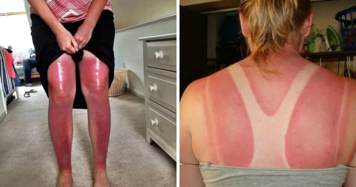 Photos de coup de soleil