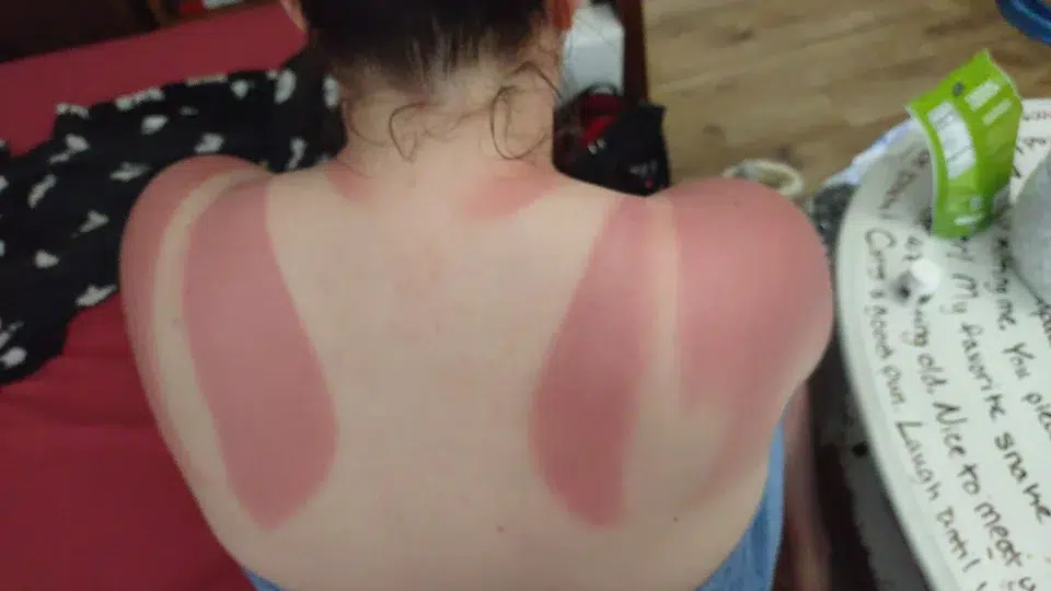 Dos brûlé au soleil