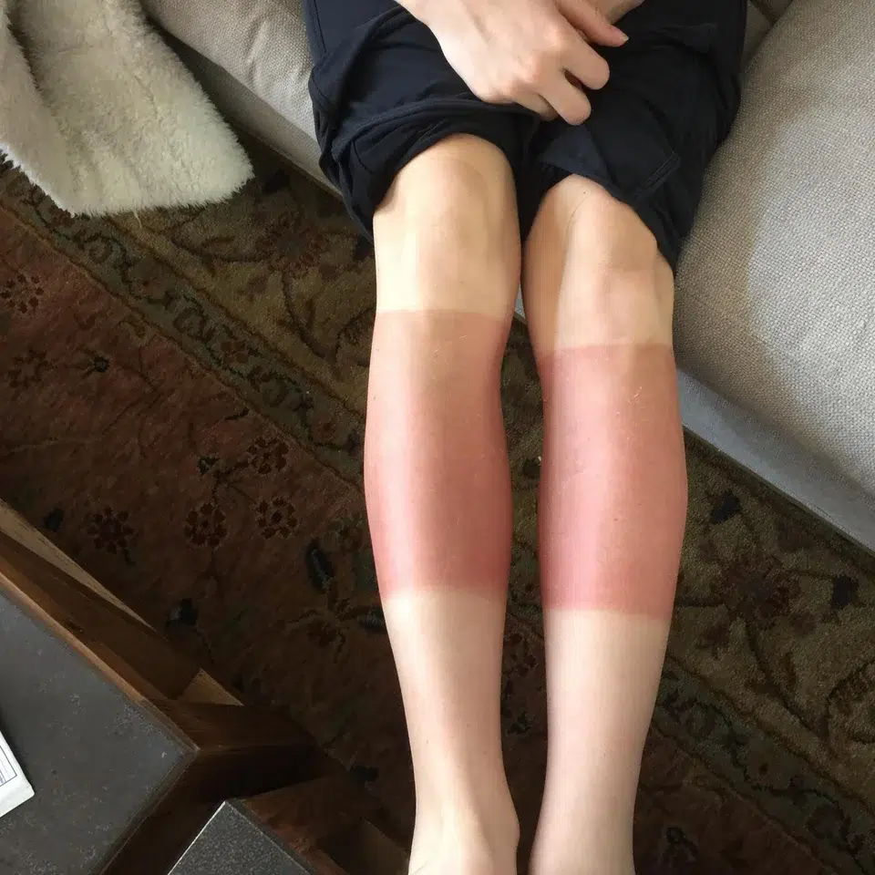 Les jambes rayées après une exposition au soleil