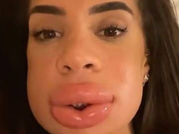 « Mon visage est déformé » : une candidate de télé-réalité totalement méconnaissable après une injection, images chocs